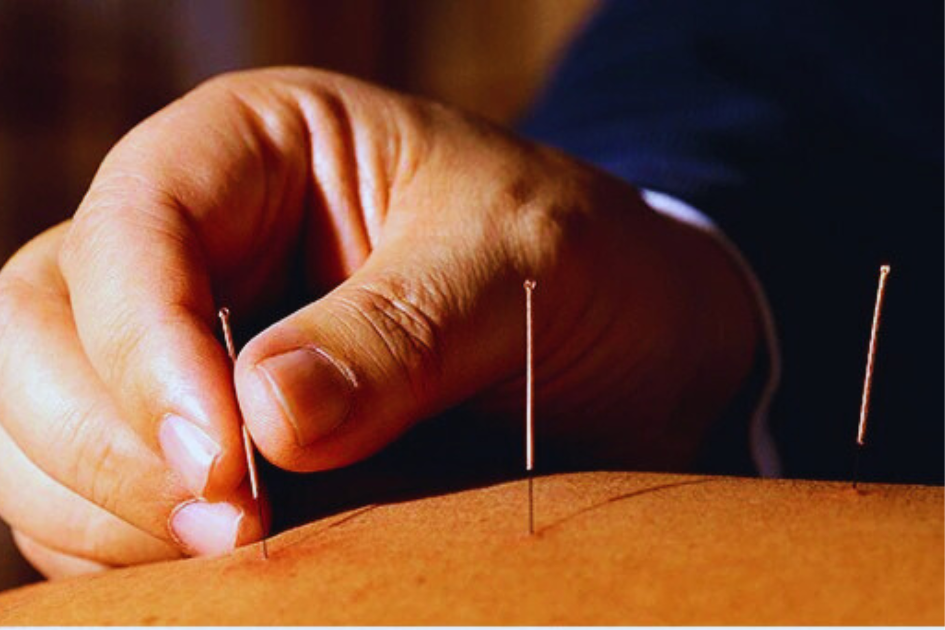 علاج تقليدي بالإبر الصينية لتحفيز نقاط الطاقة بالجسم | Séance d’acupuncture pour stimuler les points énergétiques du corps
