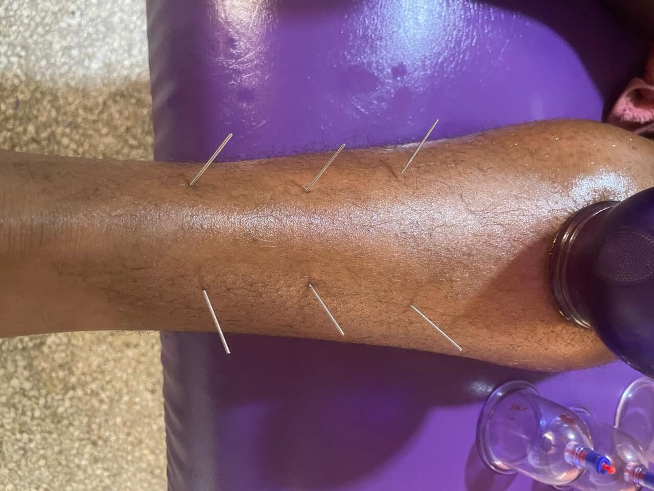 علاج تقليدي بالإبر الصينية لتحفيز نقاط الطاقة بالجسم | Séance d’acupuncture pour stimuler les points énergétiques du corps