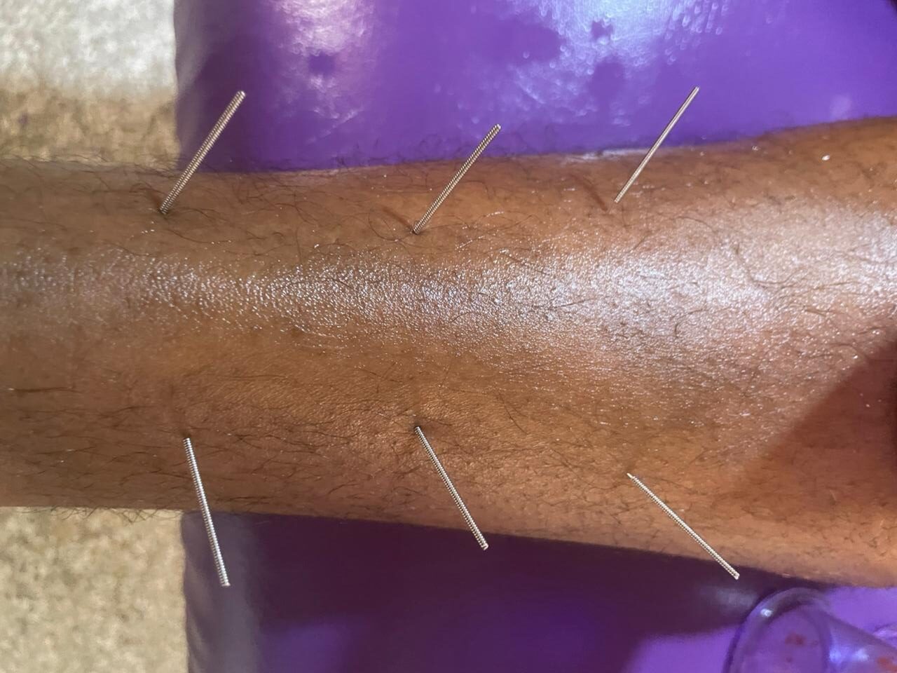 جلسة وخز بالإبر الصينية في مراكش لعلاج الآلام والتوتر علاج تقليدي بالإبر الصينية لتحفيز نقاط الطاقة بالجسم | Séance d’acupuncture pour stimuler les points énergétiques du corps