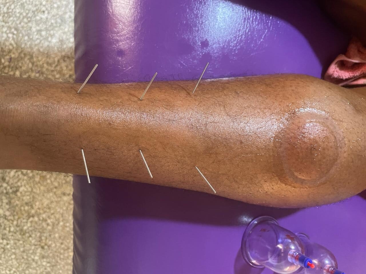 علاج تقليدي بالإبر الصينية لتحفيز نقاط الطاقة بالجسم | Séance d’acupuncture pour stimuler les points énergétiques du corps