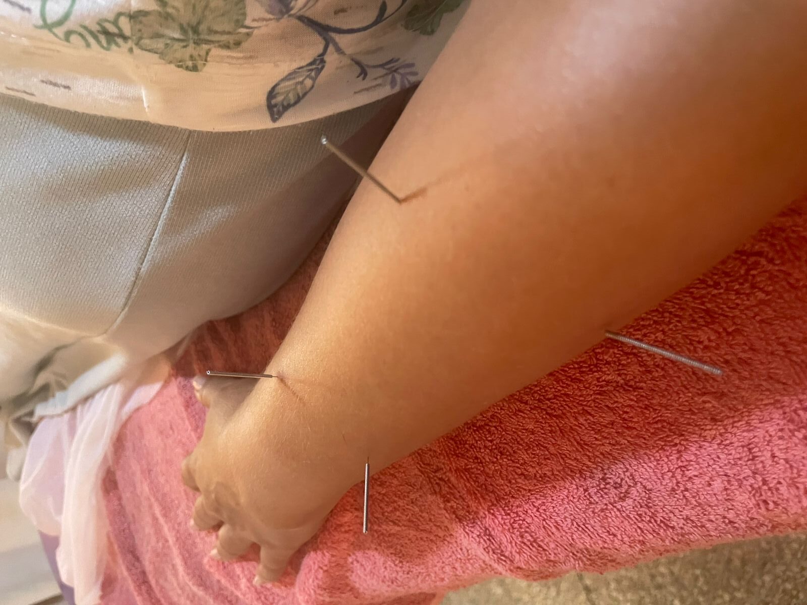 علاج تقليدي بالإبر الصينية لتحفيز نقاط الطاقة بالجسم | Séance d’acupuncture pour stimuler les points énergétiques du corps