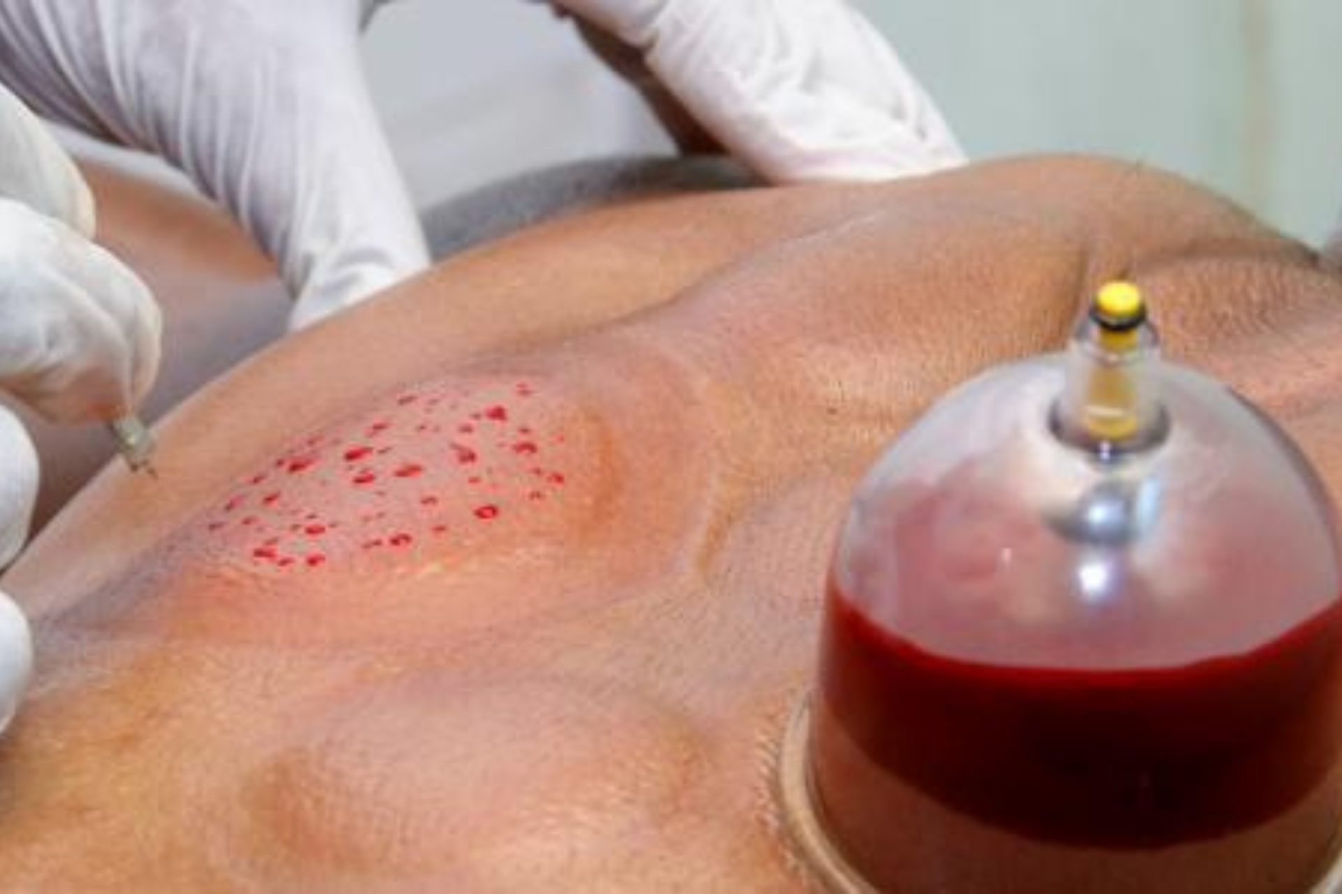 جلسة حجامة تقليدية لتنقية الجسم وتحفيز الطاقة | Séance de hijama pour purifier le corps et stimuler l’énergie