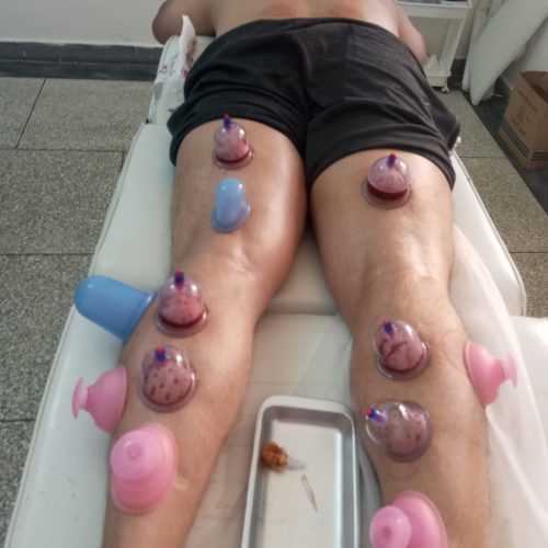 جلسة موسكا باستعمال الشيح لتسخين الجسم وتحفيز الطاقة | Moxibustion avec armoise pour chauffer et équilibrer l’énergie du corps